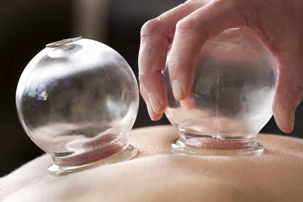 Can Cupping Work for You?